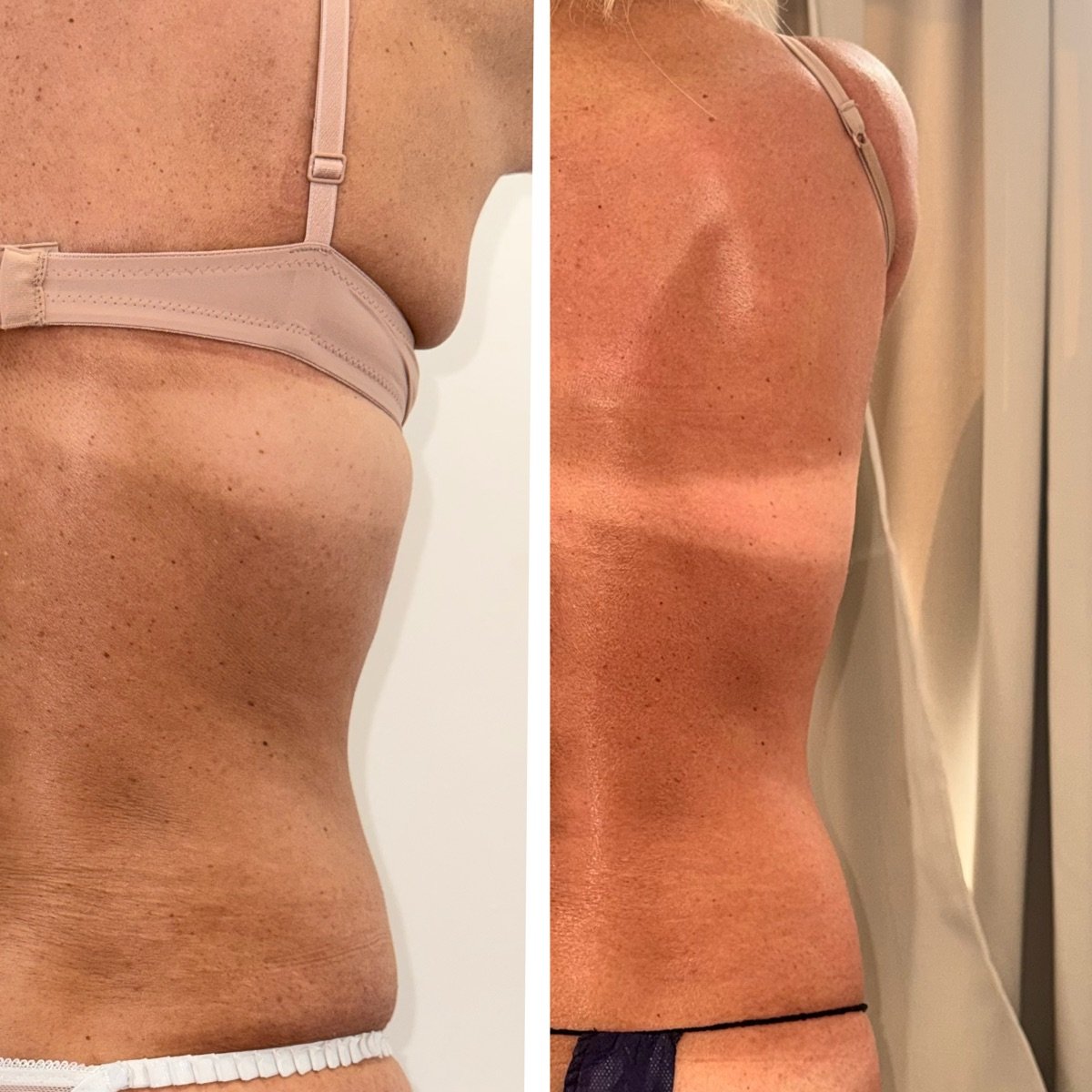 Comparação antes e depois do contorno corporal, vista lateral