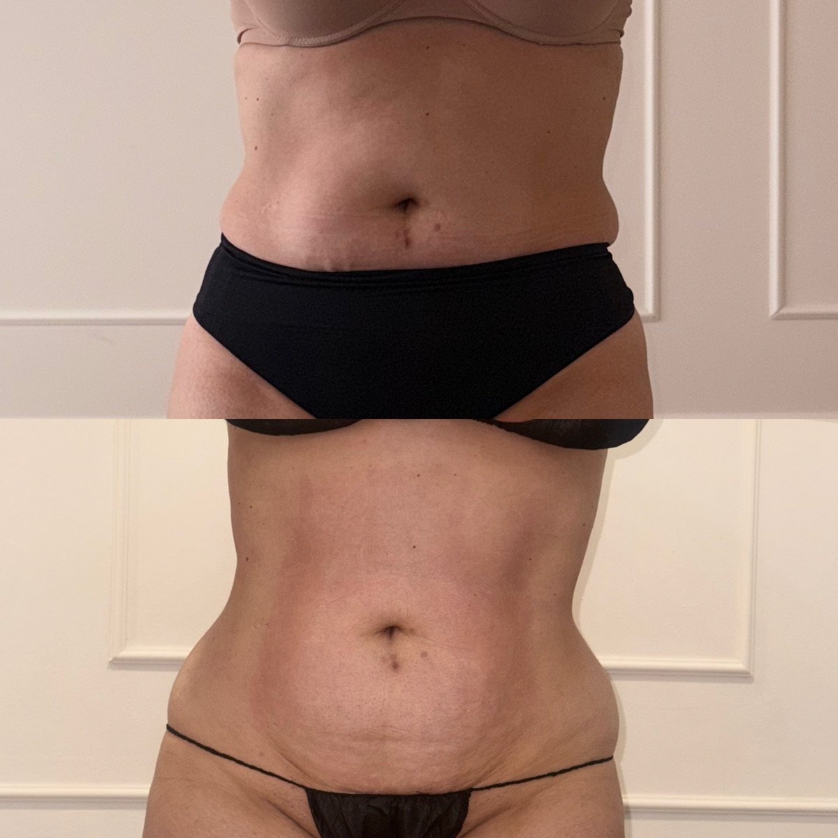 Comparação antes e depois da região abdominal, vista frontal