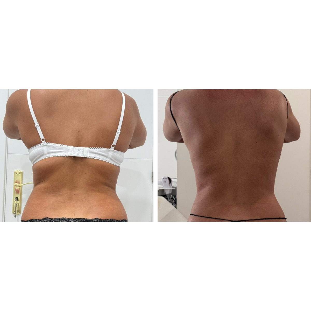 Comparação antes e depois do contorno das costas