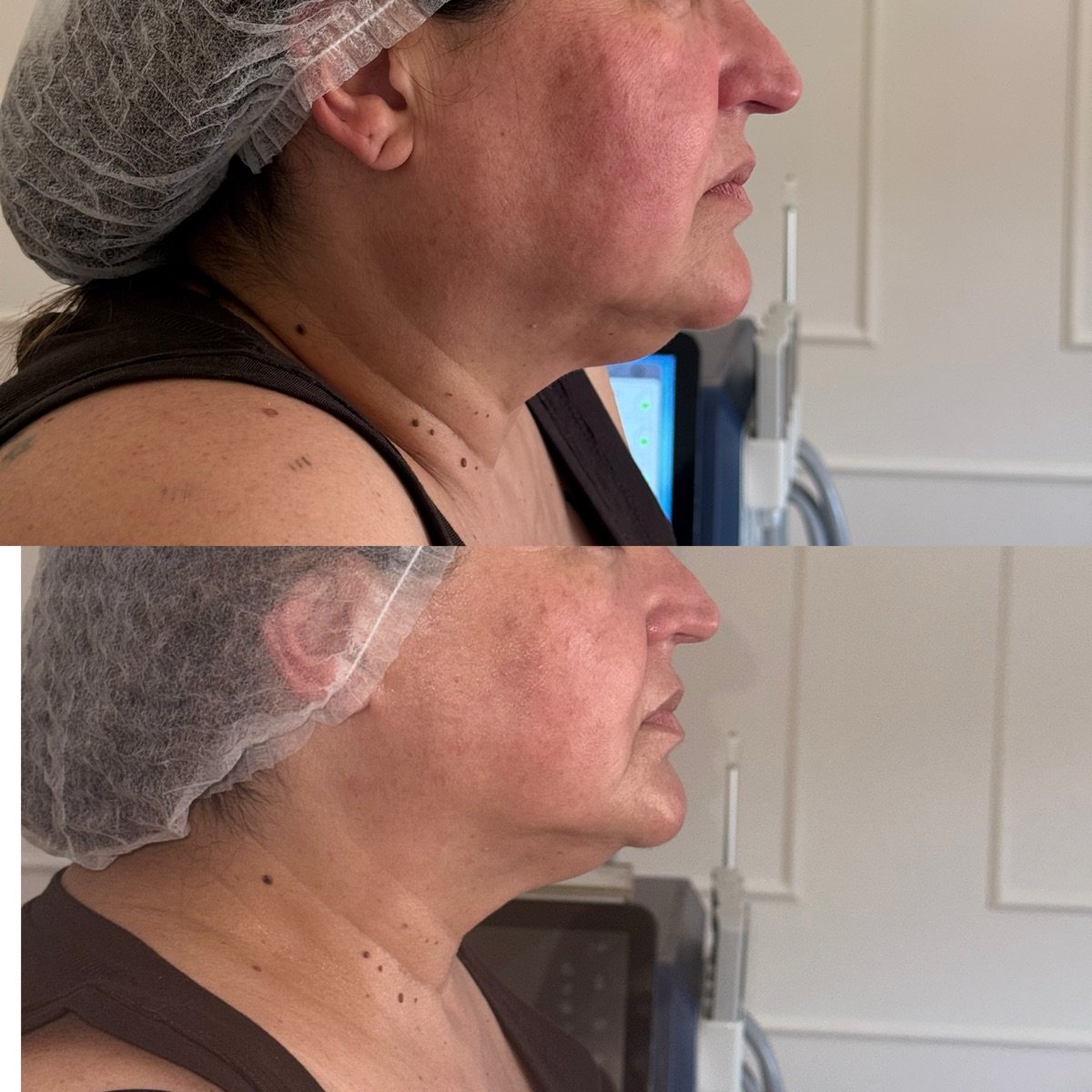 Comparação antes e depois do contorno facial, vista lateral