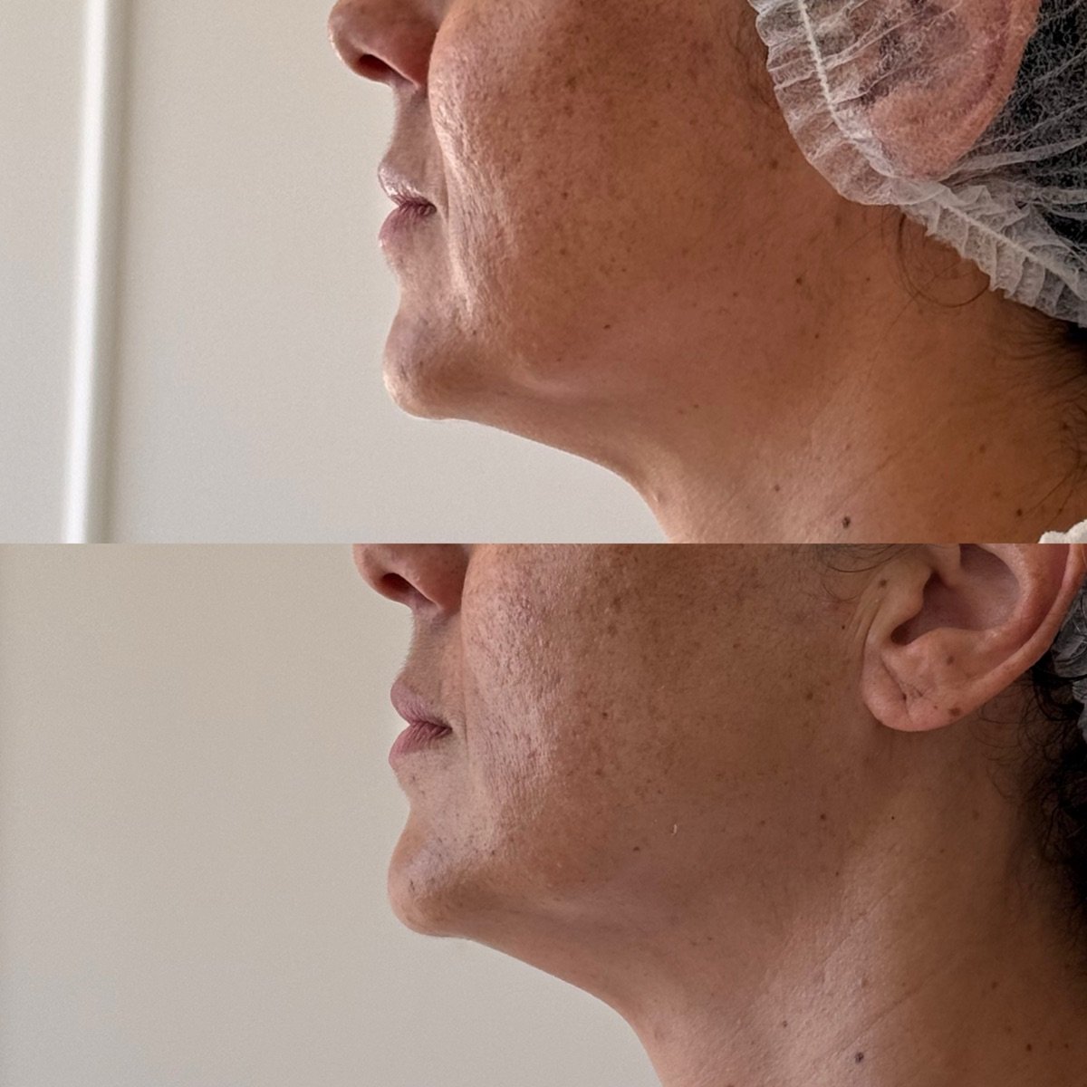 Comparação antes e depois da região mandibular, vista lateral