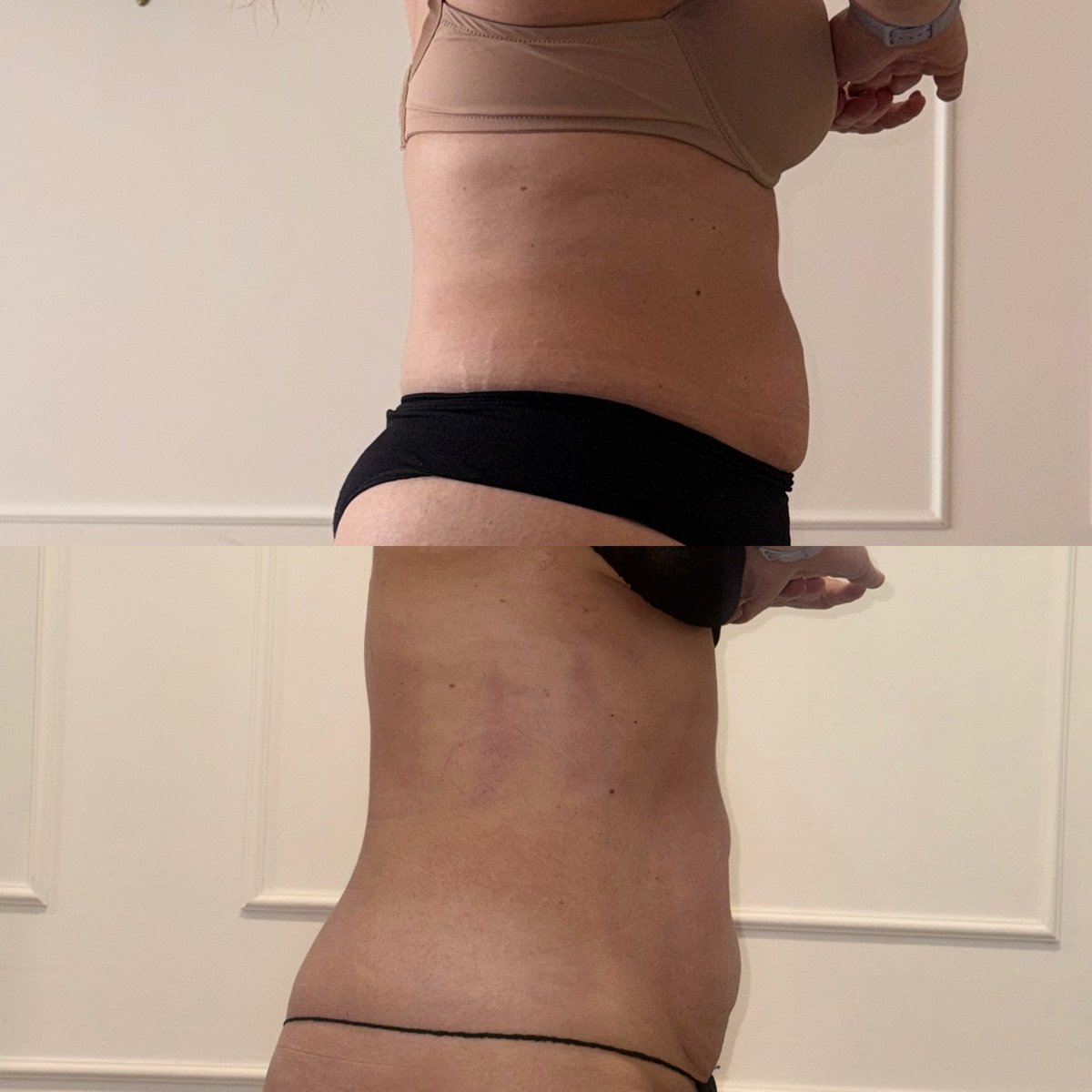 Comparação antes e depois da região abdominal, vista lateral